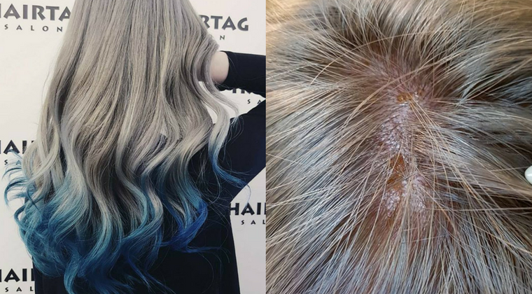 S'pore girl left with burning scalp, oozing pus from top of head after  3-hour bleaching at salon  - News from Singapore, Asia and  around the world