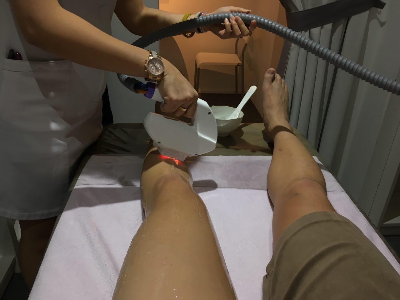laser hair removal singapore