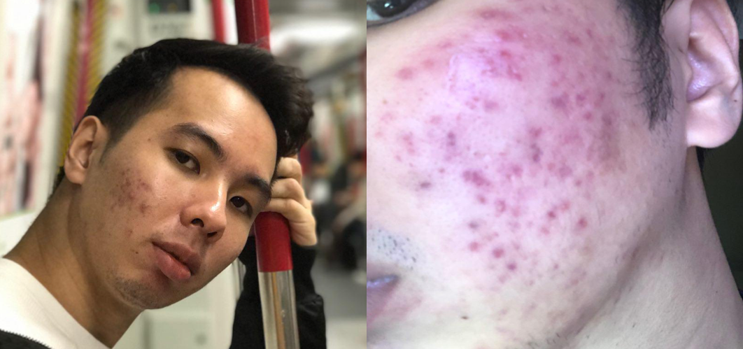 Best Acne Treatment Singapore: Clear Skin Wins!