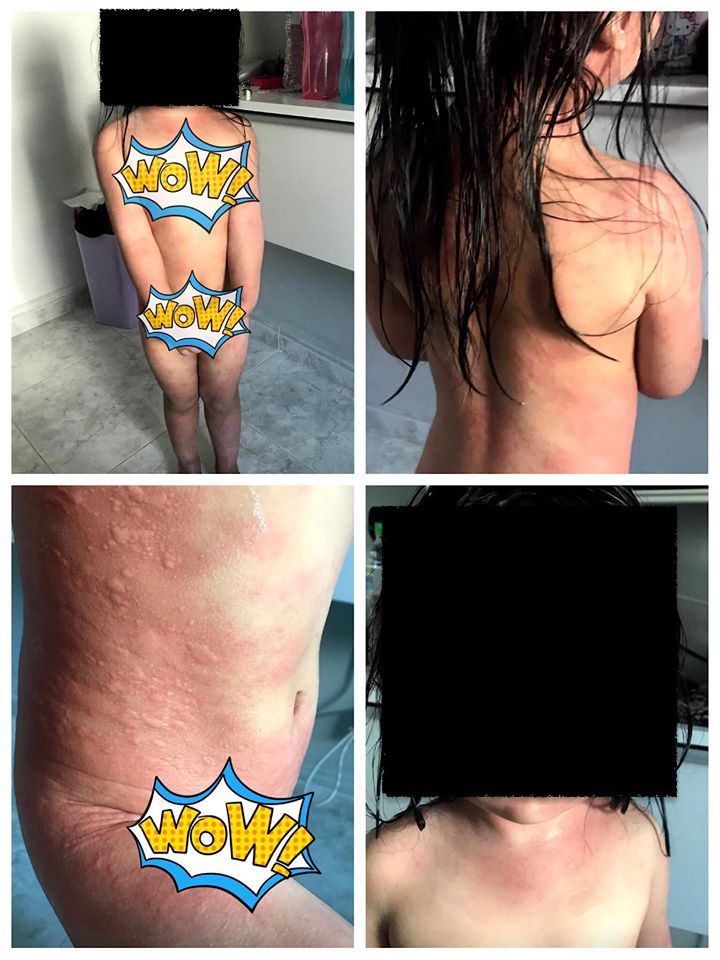 Singapore mum warns parents about daughter's chlorine rash from