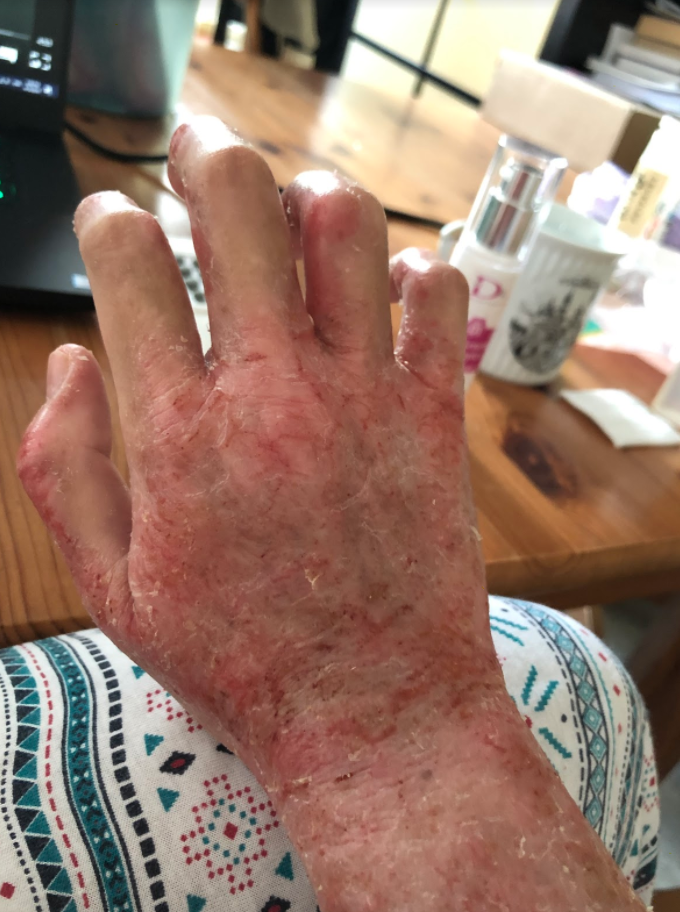 26 Year Old S Porean Woman Living With Rare Skin Condition I Thought It Was Severe Eczema Mothership Sg News From Singapore Asia And Around The World