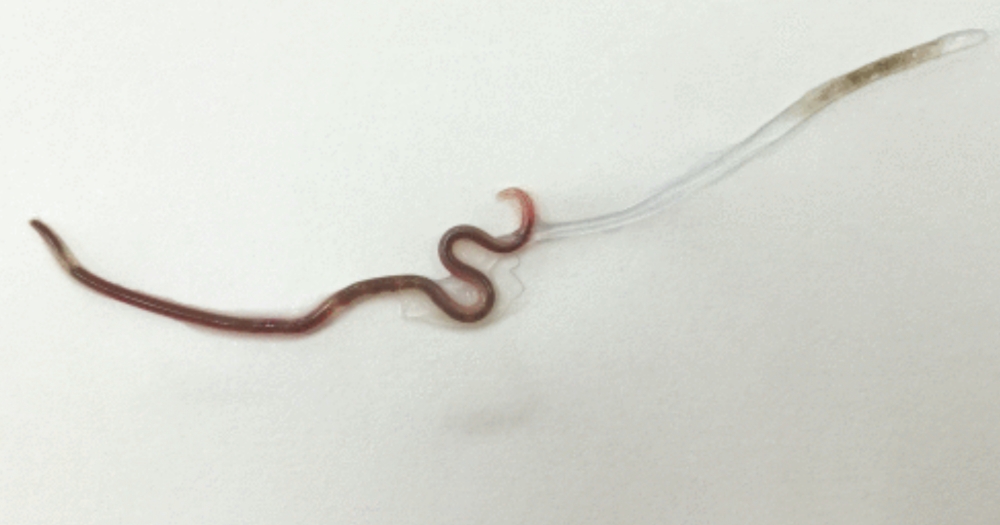 3cm-long black worm found inside Japanese woman's tonsil 5 days