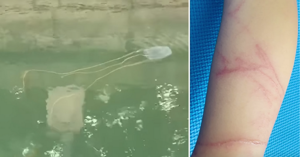 What to do if you're stung by a box jellyfish in S'pore: Don't pee on ...