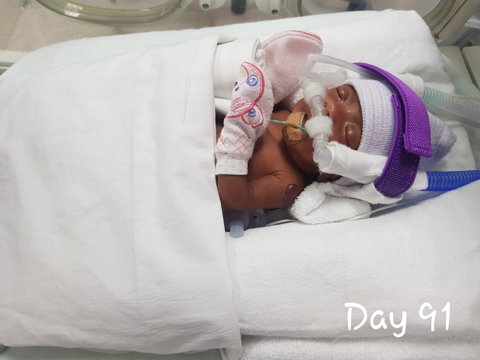 Smallest baby ever discharged from NUH weighed 345g, could not be held ...
