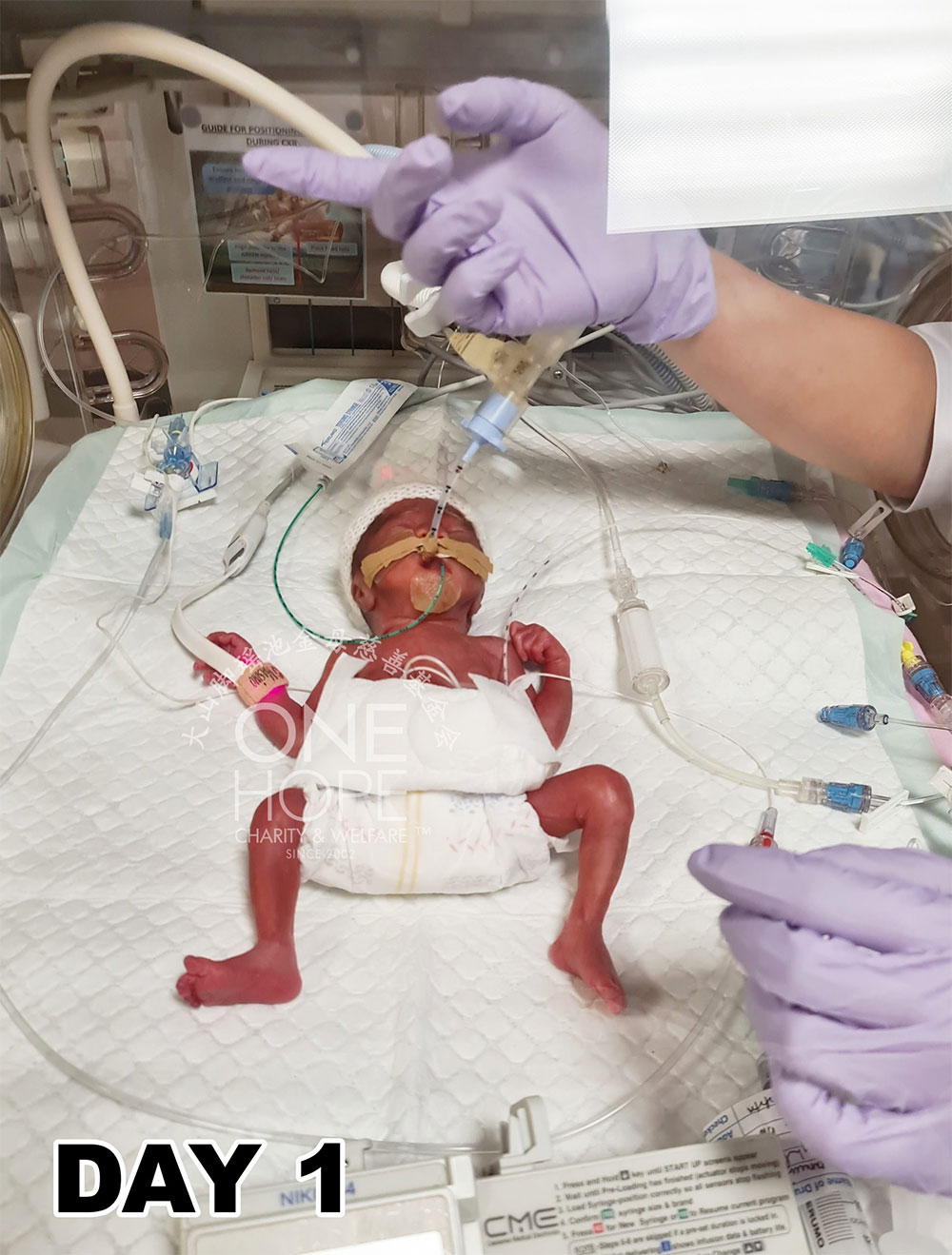 Chinese woman gives birth to premature baby weighing a 
