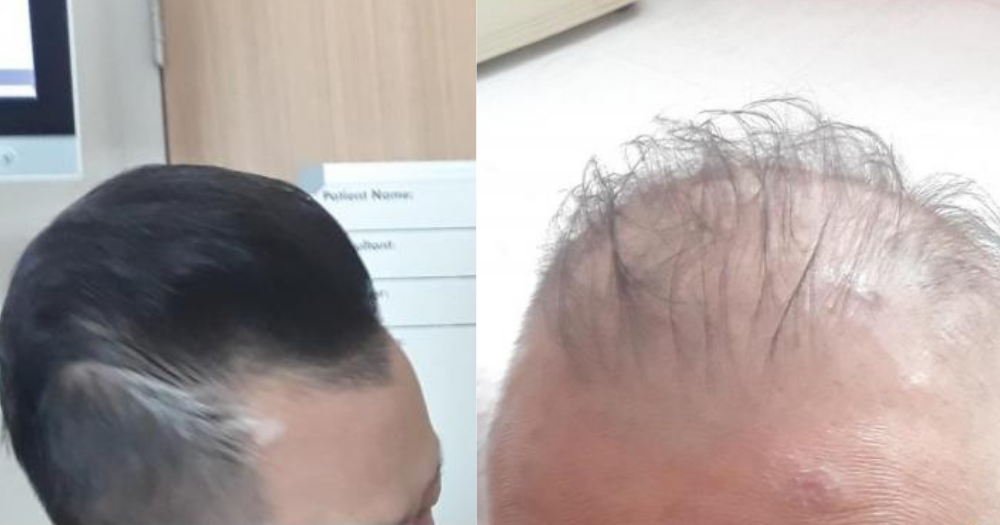 S'porean man, 66, suffers temporary hair loss for a few months after taking  vaccine  - News from Singapore, Asia and around the world