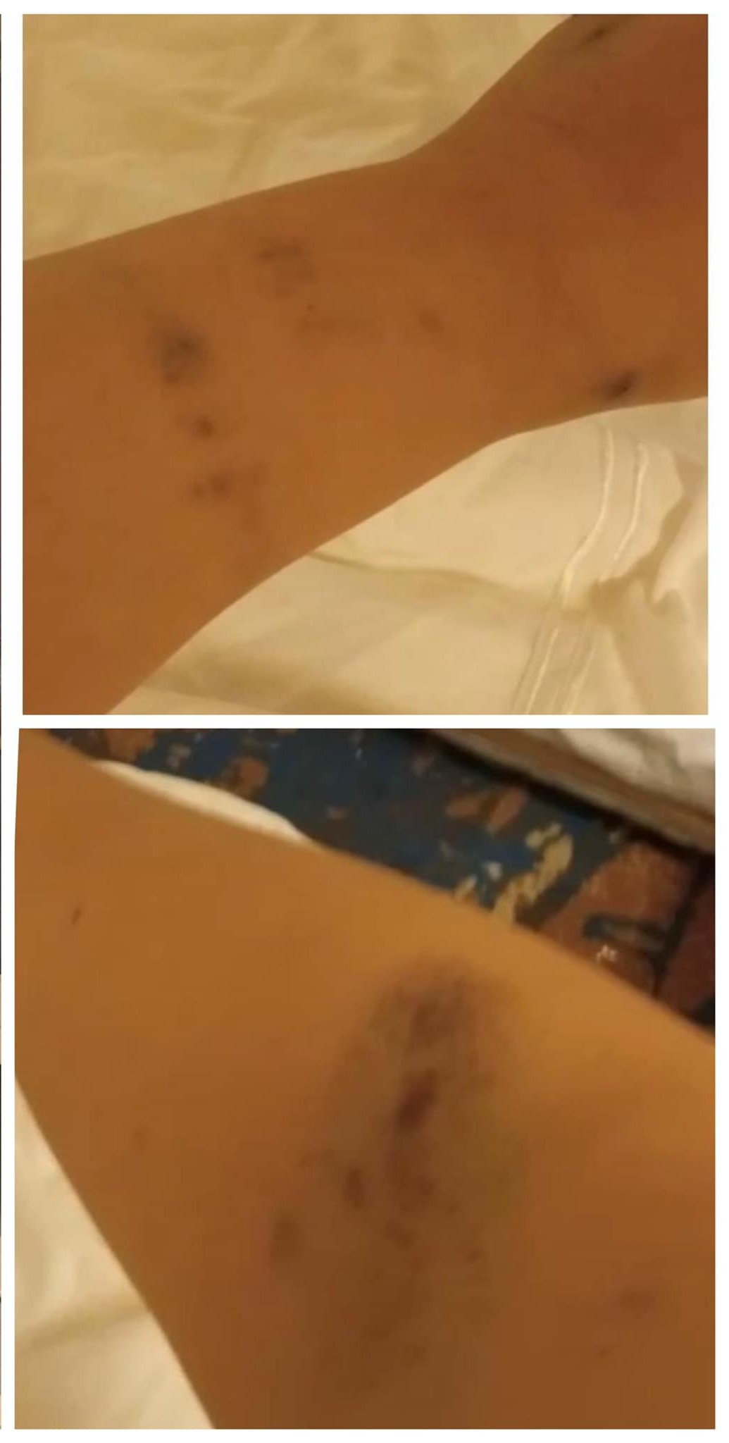 singaporean-woman-saudi-arabia-bruises.jpg