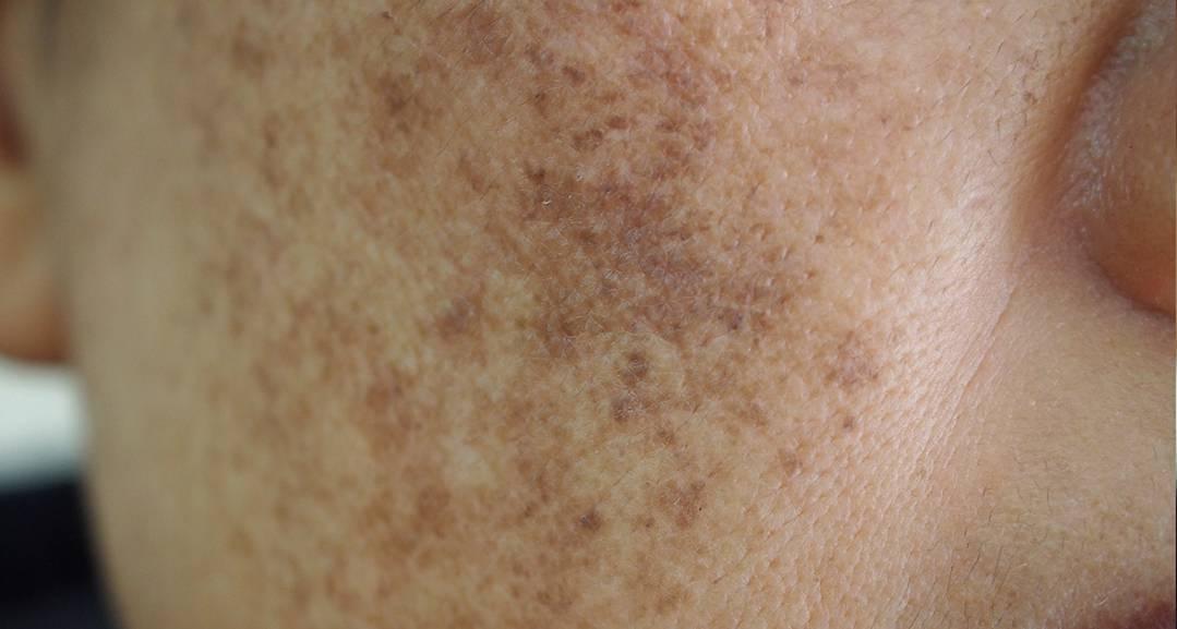 Freckles, age spots, or melasma? Pigmentation expert explains facial ...