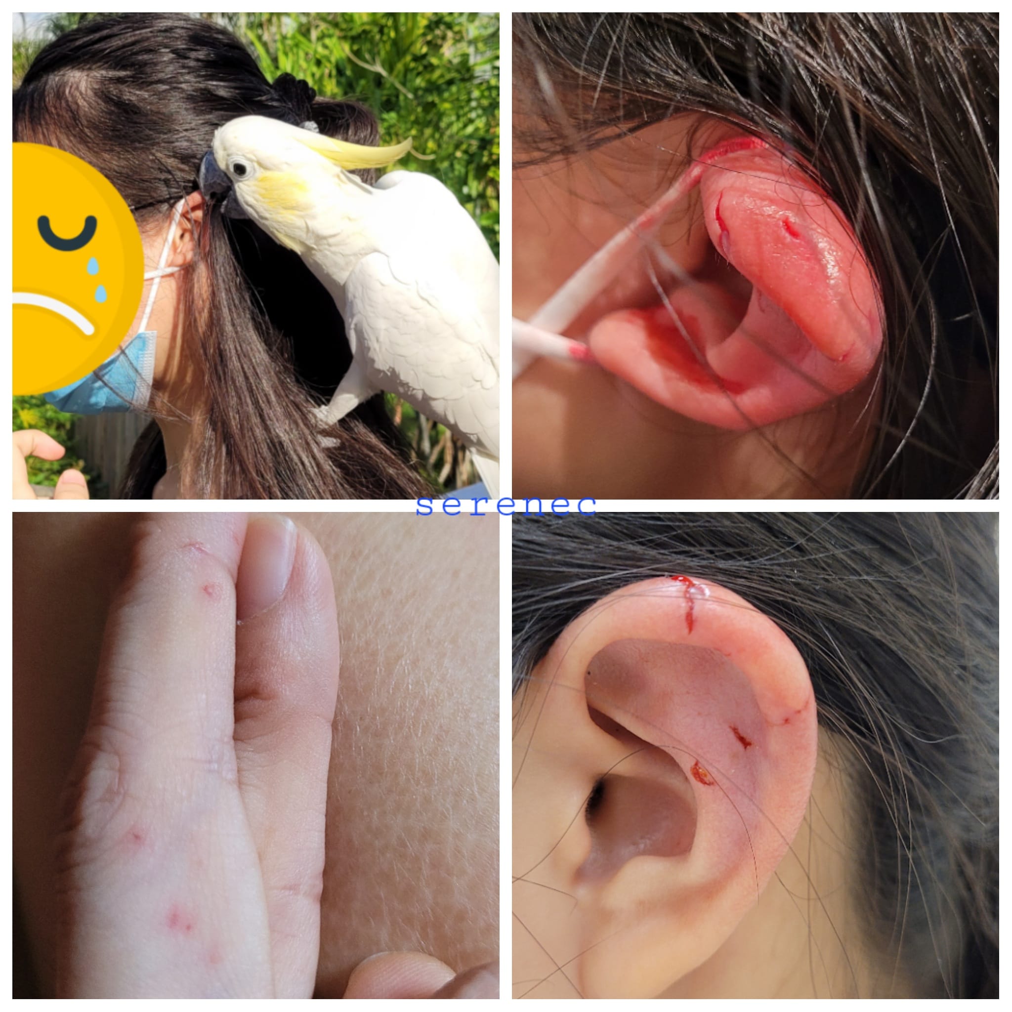 Clockwise from top left: The cockatoo perched in Chen's daughter's shoulder, Chen's daughter's ear after the incident, Chen's finger after the incident
