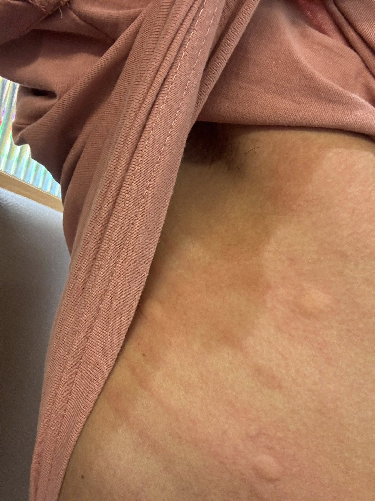 prawn-allergic-reaction.jpg