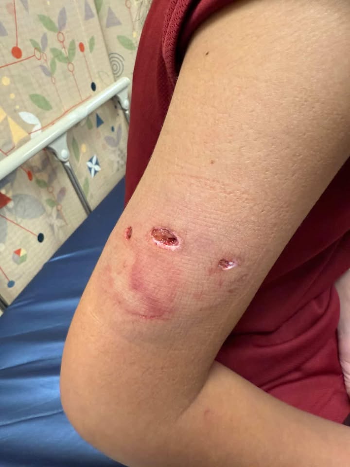 dog bite girl
