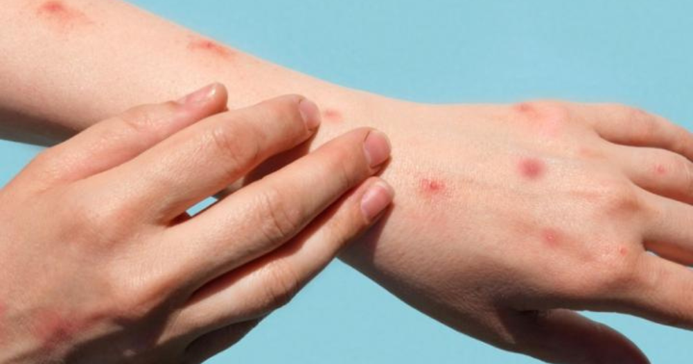 2 cases of mpox confirmed in S'pore, risk to general public is low: CDA